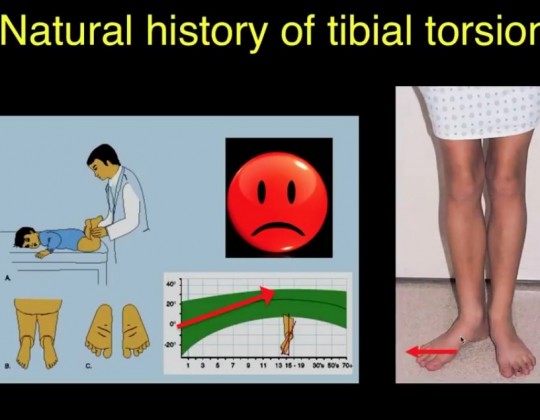 External Tibial Torsion by Prof Lynn Staheli